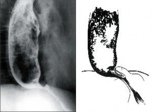 Obr. 25 - Stav po Backer-Gröndahlově anastomóze doplněné trunkální vagotomií a pyloroplastikou u 69leté ženy