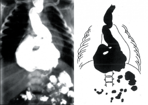 Obr. 7a Rentgenový obraz up-side-down stomach u 8denního chlapce s neúplnou obstrukcí v oblasti pyloruí
