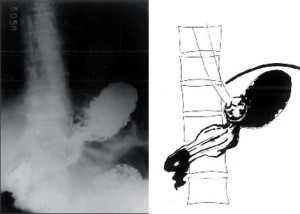 Obr. 12b - Po založení Nissen-Rossettiho fundoplikace se v oblasti kardie zobrazuje typický „pseudotumor“ a k vybavení gastroezofageálního refl uxu nedochází ani v Trendelenburgově poloze