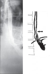 Obr. 4a - Fixovaná skluzná hiátová hernie s brachyezofagem a mírnou marginální strikturou
