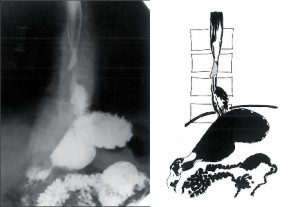 Obr. 7 – Skluzná hiátová hernie, brachyezofagus a marginální kalózní vřed jícnu
