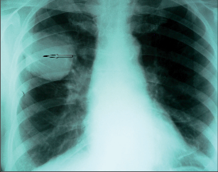 Obr. 1 – Karcinom horního laloku pravé plíce (skiagram)