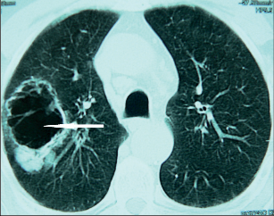Obr. 2 – Nádorová kaverna pravé plíce (CT)