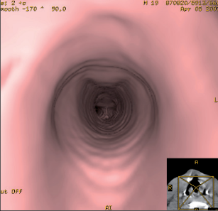 Obr. 3 – Virtuální tracheoskopie po sutuře ruptury průdušnice s normálním nálezem