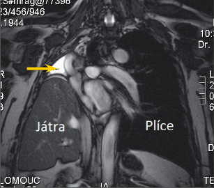 Obr. 4 – MRI rekonstrukce po rozšířené pravostranné pneumonektomii, šipka označuje zbytkovou pleurální dutinu