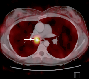Obr. 5 – Recidiva karcinoidu ve spojném bronchu 15 let po horní lobektomii (PET-CT)
