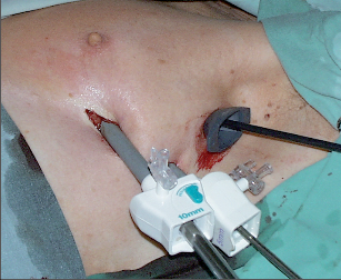 Obr. 9 – Porty pro videotorakoskopii v poloze na zádech pro operaci v předním mediastinu