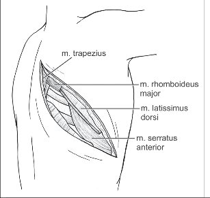Obr. 11 – Posterolaterální torakotomie