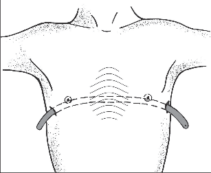 Obr. 2 – Princip miniinvazivní korekce vpáčeného hrudníku