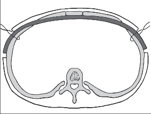 Obr. 3 – Retrosternálně uložená dlaha fixuje vpáčený segment v uspokojivé pozici