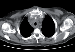 Obr. 5 – Poststernotomická osteomyelitida s retrosternálním abscesem