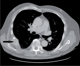 Obr. 6 – Skeletální metastáza karcinomu ledviny (označena šipkou)