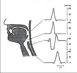 Obr. 3<br />Přibližné tlaky ve faryngu, oblasti HJS a krčním jícnu během polykacího aktu