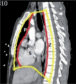Obr. 1 – Kompartmenty mediastina dle Shieldse (P – přední, S – střední, Z – zadní)