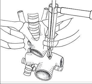 Obr. 5 – Přední mediastinoskopie