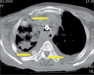 Obr. 8 – CT u mediastinitidy s bilaterálním výpotkem (označeno šipkami)