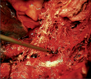 Obr. 12 – Cystický lymfangiom mediastina