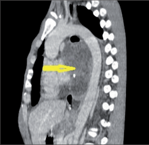 Obr. 13 – Smíšený germinální tumor středního a zadního mediastina