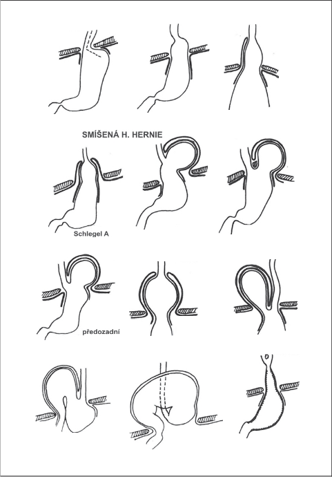 Obr. 1 – Různé typy hiátových hernií se znázorněním jejich kýlních vaků
