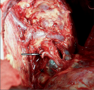 Obr. 4 – Rozšířená bronchiální tepna u plíce destruované bronchiektáziemi