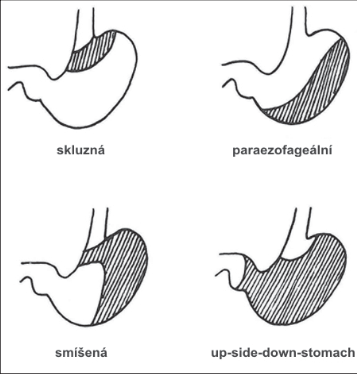 Obr. 2 – Rozsah herniované části žaludku do mediastina u různých typů hiátové hernie