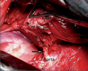 Obr. 6 – Tepna vystupující do sekvestrace z descendentní aorty je označena šipkou