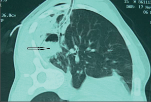 Obr. 8 – Drenáž abscesu pod CT navigací