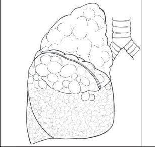 Obr. 11 – Staplerová tangenciální resekce z bulózně změněného horního laloku