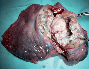 Obr. 14 – Kavitovaný karcinom horního laloku