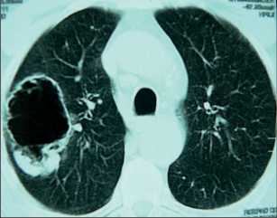 Obr. 15 – CT nádorové (Joresovy) kaverny horního laloku vpravo