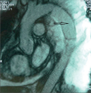 Obr. 16 – MR aortografie po náhradě descendentní aorty v rámci pneumonektomie pro karcinom
