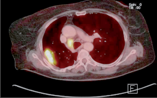 Obr. 17 – Patologická akumulace 6-FDG v recidivě tumoru pravé plíce a v paratracheální uzlině