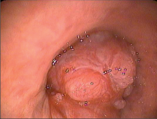 Obr. 18 – Bronchoskopický nález u karcinomu plic