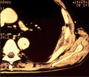 Obr. 22 – Karcinom prorůstající do hrudní stěny pod lopatkou