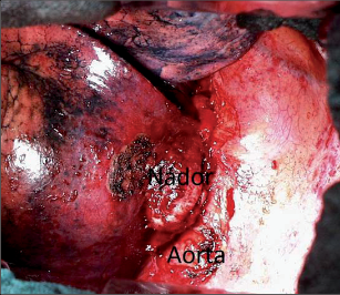 Obr. 23 – Karcinom prorůstající do descendentní aorty