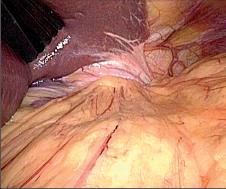 Obr. 17 – Laparoskopický pohled do dutiny břišní u pacienta s upside-down stomachem, kde je žaludek dislokován hiátem do mediastina