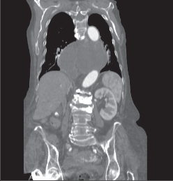 Obr. 16 – CT obraz upside-down stomachu v transverzálním řezu