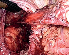 Obr. 18 – Vypreparovaný jícnový hiátus po repozici žaludku a resekci kýlního vaku, před hiatorafií a založením fundoplikace