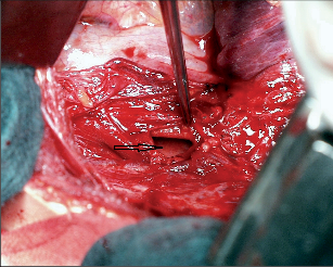 Obr. 2 – Ruptura průdušnice způsobená při intubaci v rámci resuscitace