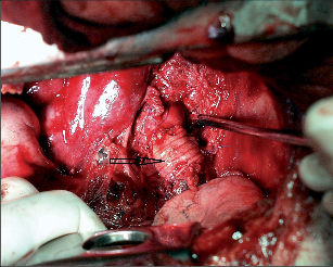 Obr. 3 – Traumatická ruptura isthmu aorty ošetřená krátkou dakronovou protézou