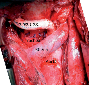 Obr. 4 – Náhrada truncus brachiocephalicus a sutura průdušnice pro sdružené poranění