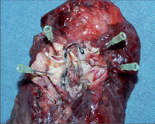 Obr. 6 – Operační preparát levé plíce odstraněné pro centrální tumor