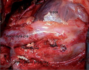 Obr. 7 – Plicní hilus vpravo a jeho cévy ošetřené intraperikardiálně