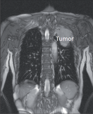 Obr. 11 – Pancoastův nádor levého plicního hrotu