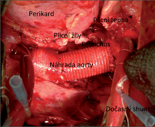 Obr. 14 – Intraperikardiální pneumonektomie s náhradou descendentní aorty