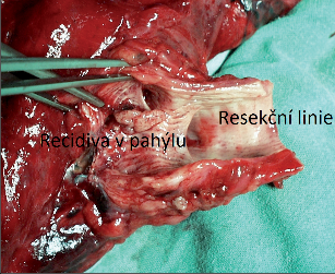Obr. 16 – Recidiva tumoru v dlouhém pahýlu dolní průdušky