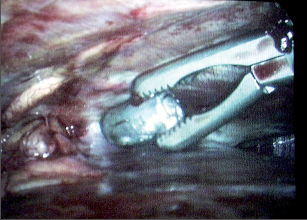 Obr. 4 – Extrakce projektilu z pleurální dutiny