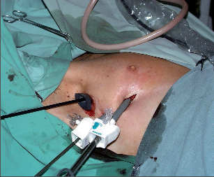 Obr. 6 – Pozice portů pro operaci v předním mediastinu