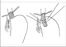 Obr. 18 – Původní technika Nissenovy fundoplikace