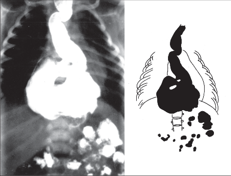 Obr. 2 – Rentgenový obraz up-side-down stomach u 8denního chlapce s neúplnou obstrukcí v oblasti pyloru